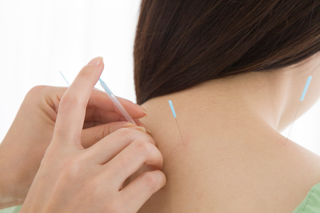 Woman doing acupuncture treatment
